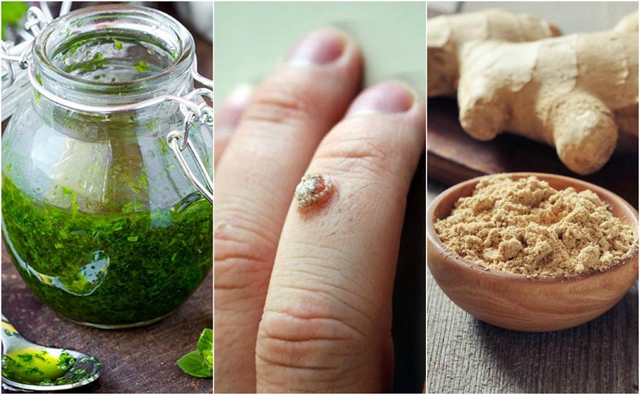 5 effective remedies against warts on the skin