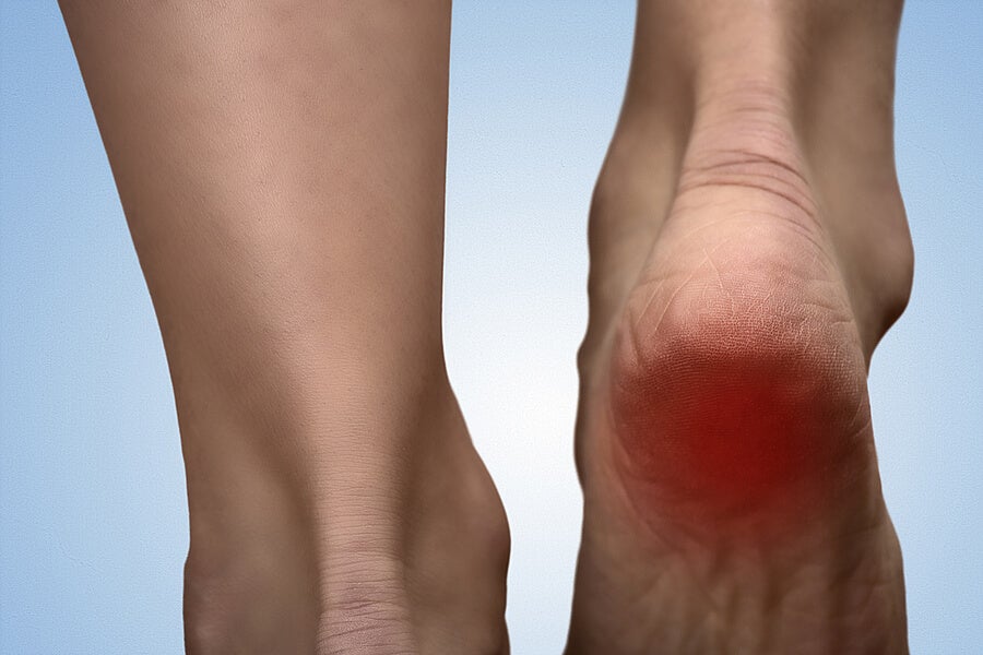 5 remedies for heel spurs