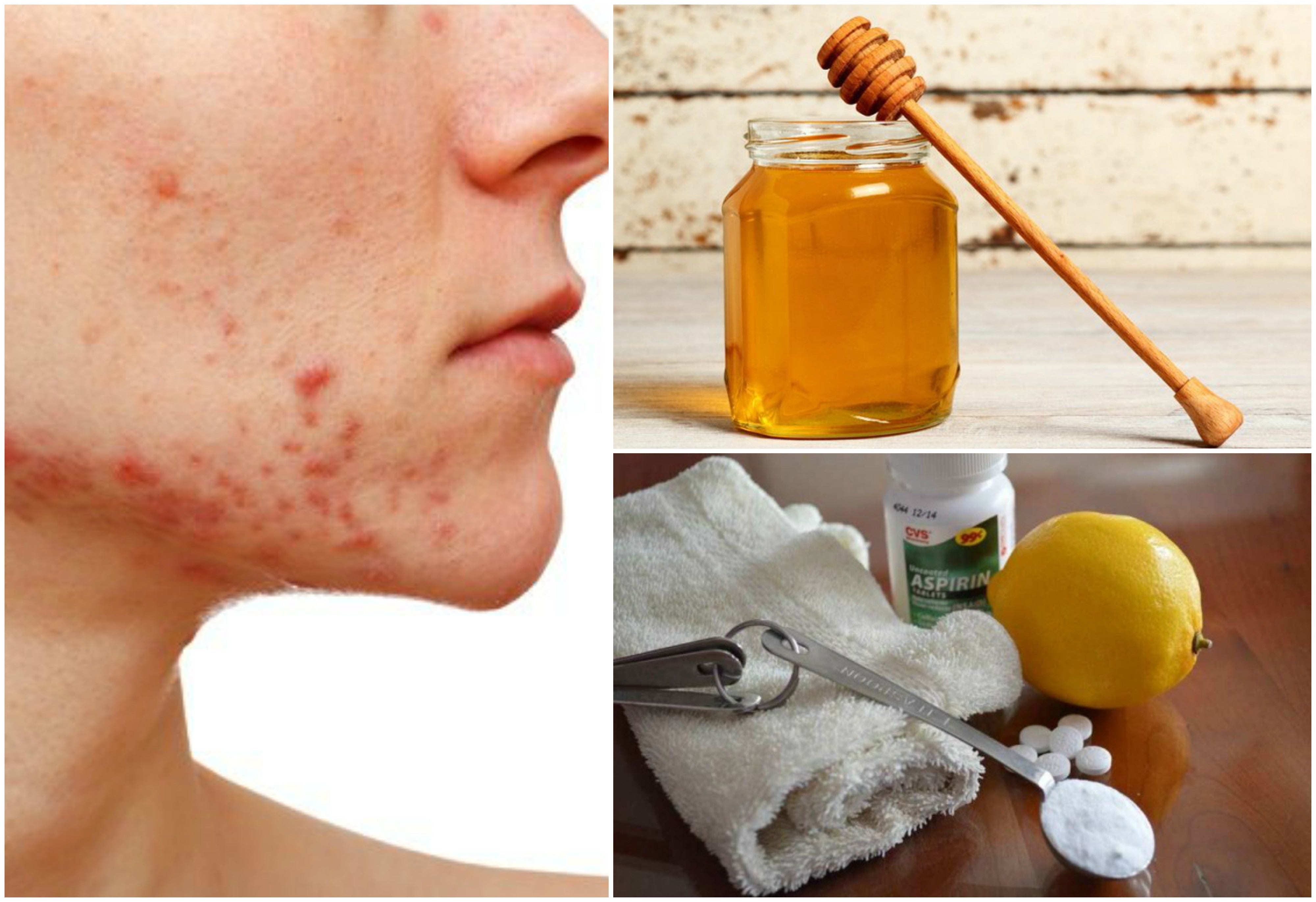 6 natural remedies to deal with cystic acne