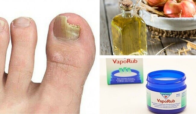 6 simple remedies to eliminate nail fungus