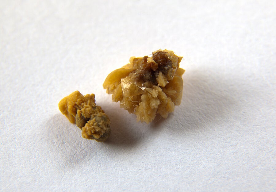 Kidney stones kidneys