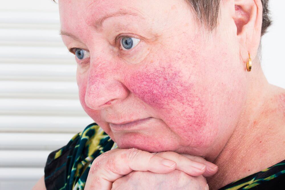 Woman with rosacea