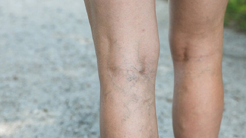 varicose veins (2)