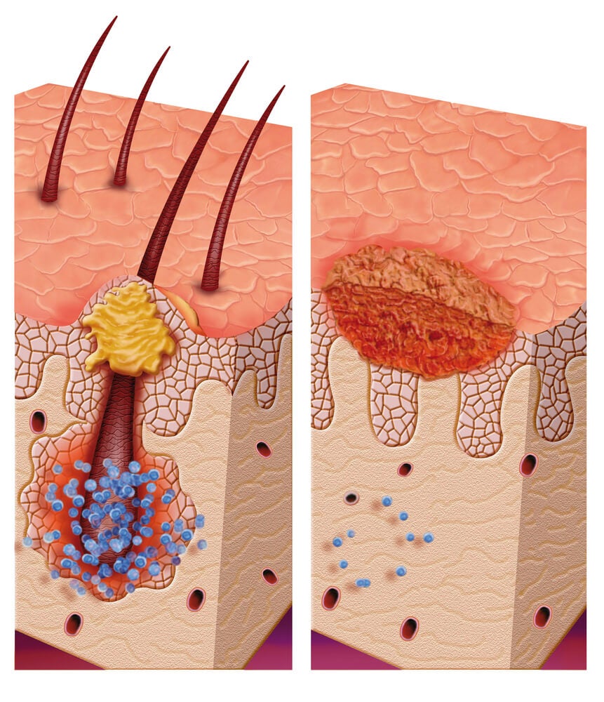 pilomatricoma hair follicle tumor