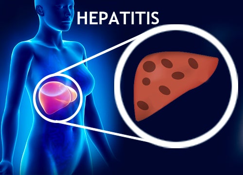 Hepatitis