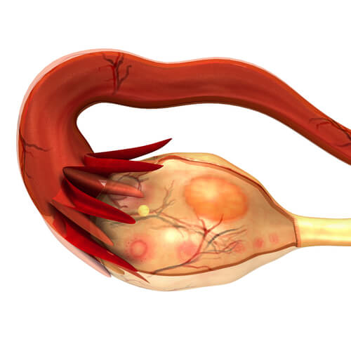 Polycystic ovary syndrome is one of the diseases of the ovaries