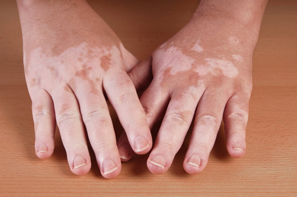 White spots or hypopigmentation