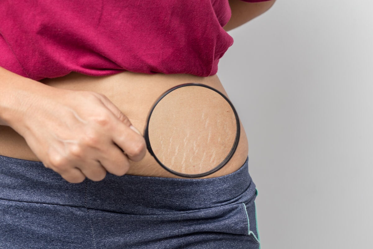 Stretch marks on the abdomen with cellulite.