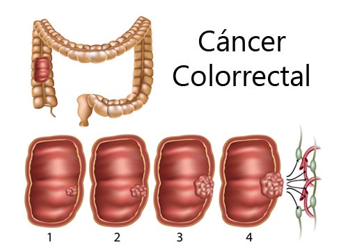 colorectal cancer in women