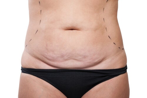 tummy tuck