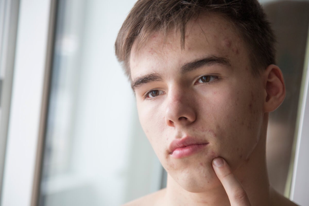 Young man with acne.